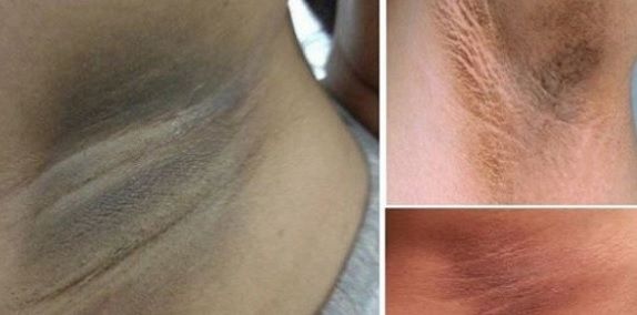 Masaca minune care îţi albeşte pielea de la subraţ