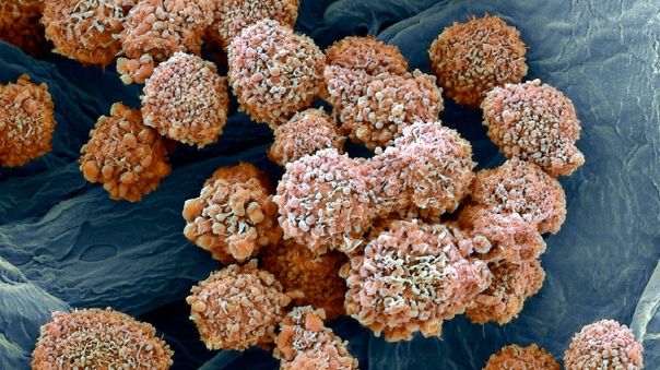 Adevărul despre răspândirea cancerului a ieşit la iveală! Cum se propagă boala