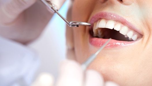 Albirea dinţilor acasă, în doar 3 minute! Cum se face