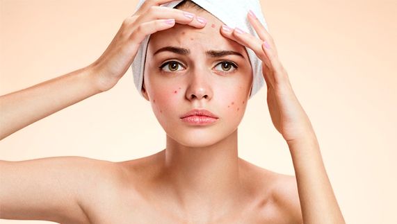 Scapă definitiv de acnee cu aceste tratamente naturiste