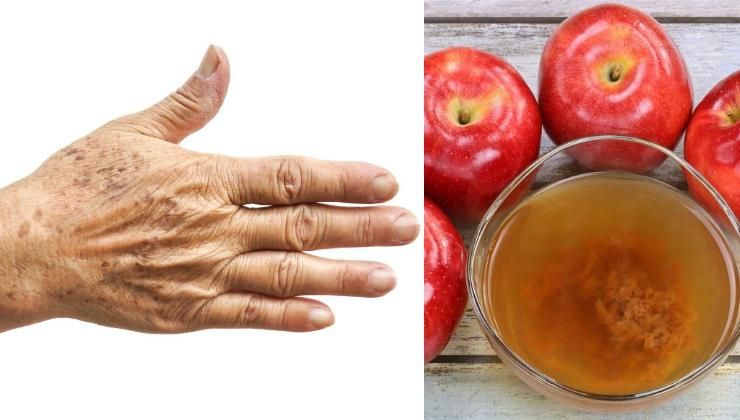 Cum să scăpaţi de petele de vârstă cu un singur amestec 