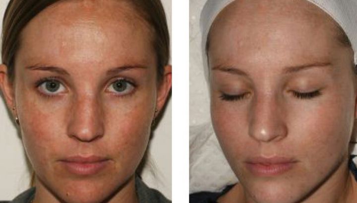 Acestea sunt primele semne că suferi de o boală gravă: ciroza hepatică