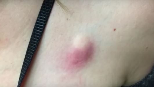 S-a trezit cu o mică înțepătură, însă în 2 zile s-a transformat complet. Când a mers la doctor. ȘOC