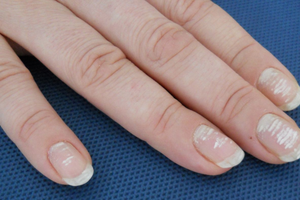 V-aţi întrebat vreodată ce sunt liniile albe de pe unghii? Iată răspunsul!