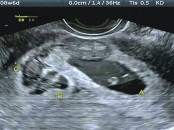 Însărcinată cu o fetiță, a mers la ecograf. Verdict șoc: ce apăruse în burtă, lângă copil