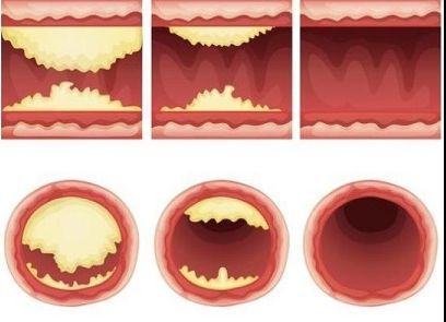 Fructul care deblochează arterele. Cum să previi bolile inimii