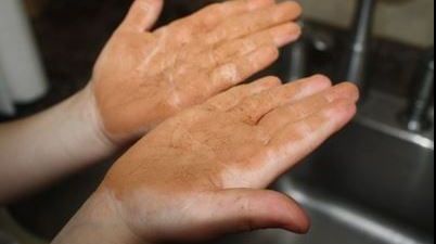 Tot ce trebuie să ştii despre "boala mâinilor murdare"