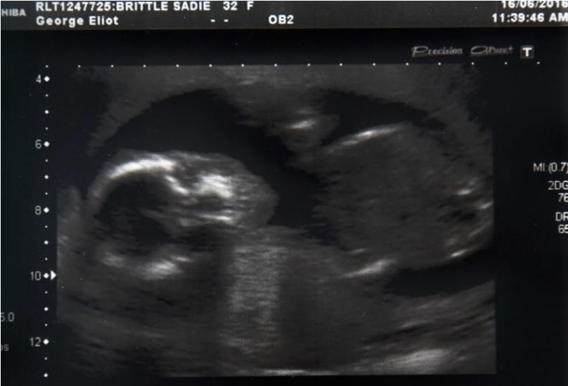 A pierdut sarcina și a fost devastată. Apoi, a observat că burta ei crește. Ce a aflat la medic: ȘOC