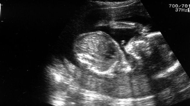 Însărcinată, a făcut ecografie la 12 săptămâni. Medicii s-au îngrozit: Ăsta nu e un copil 