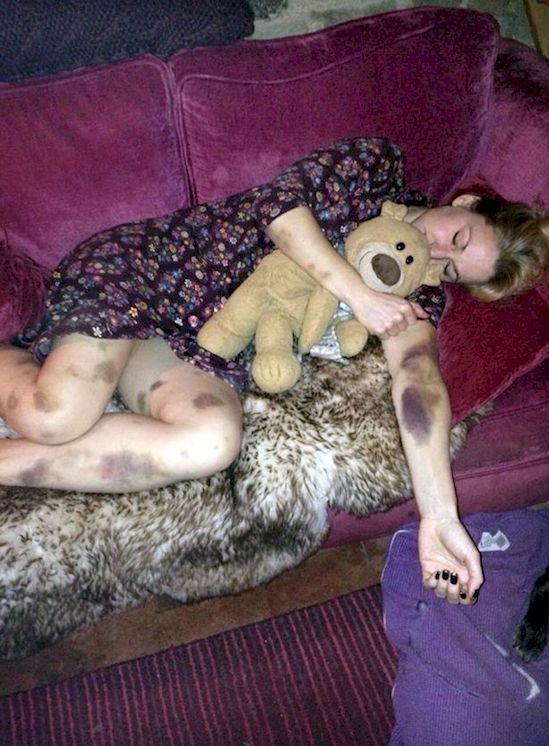 S-a culcat sănătoasă, dar s-a trezit plină de vânătăi. Ce s-a întâmplat peste noapte. S-a ÎNGROZIT