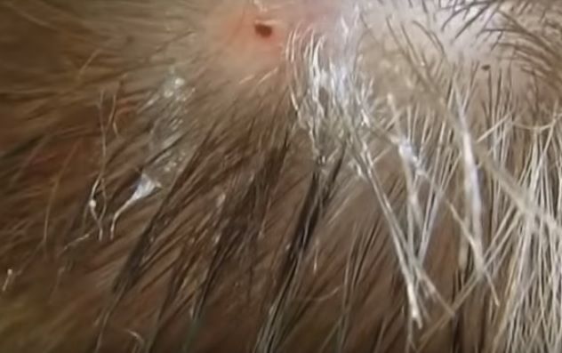 A mers în vacanţă în Panama. A simţit că un parazit i-a intrat în cap. ŞOC! Ce a scos după o lună