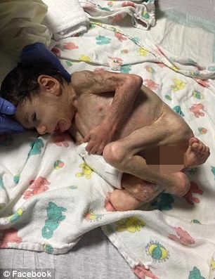 Transformare incredibilă a unui orfan din Bulgaria, după ce a fost ADOPTAT. La 7 ani, avea 3 kg