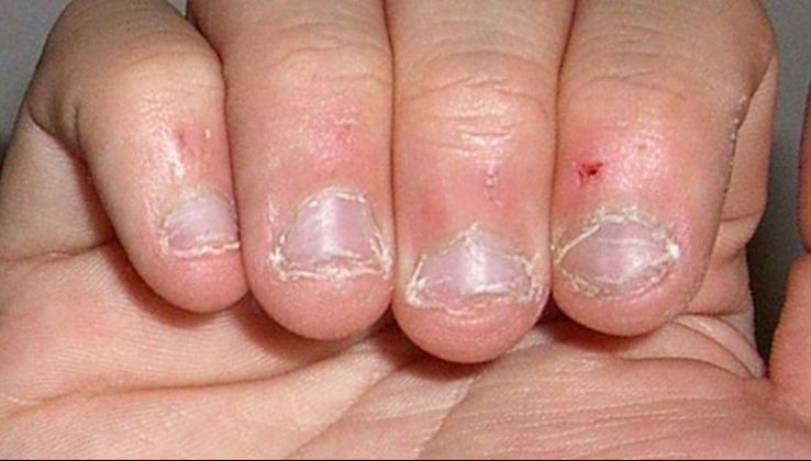 Un bărbat de 40 de ani a murit din cauză că își rodea unghiile. Cât de periculos e acest obicei