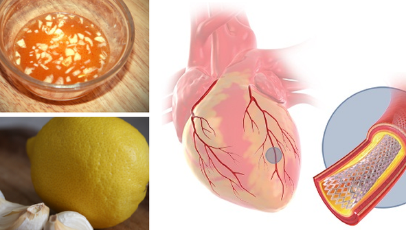 A amestecat suc de lămâie cu usturoi pisat! Ce s-a întâmplat cu inima ei e incredibil!