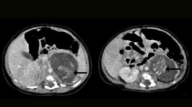 S-a născut cu doi bebeluşi "în ea". Povestea impresionantă a celei mai tinere mame din lume 