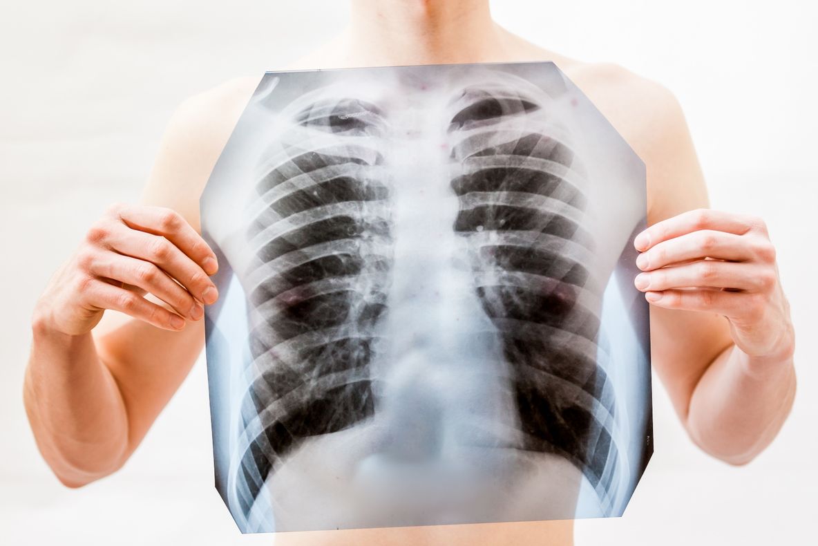 Cele mai agresive forme de cancer