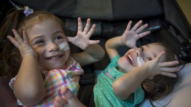 Povestea INCREDIBILĂ a gemenelor siameze care AU UIMIT lumea medicinei