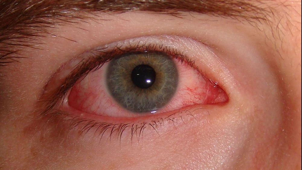 De ce ni se înroșesc ochii. Poate fi semn al unei boli serioase