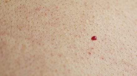 Ce sunt, de fapt, ALUNIŢELE ROŞII care apar pe corp