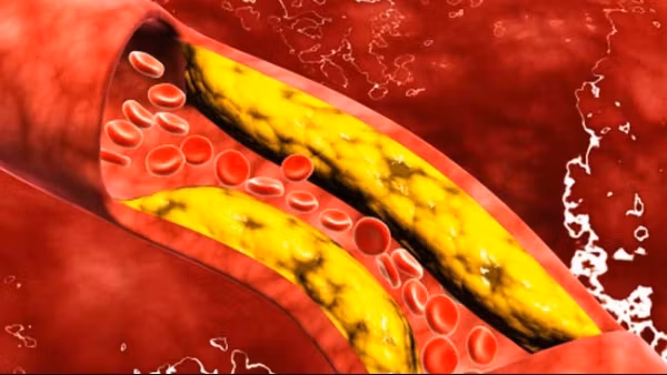 Ce nu-ţi spune medicul despre colesterol. Motivul pentru care nu este bine să iei medicamente