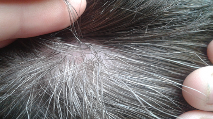 Incredibil! Ai aşa ceva în păr? Nu o să faci cancer NICIODATĂ!