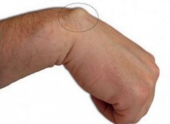 Cel mai rapid tratament naturist pentru lipoame