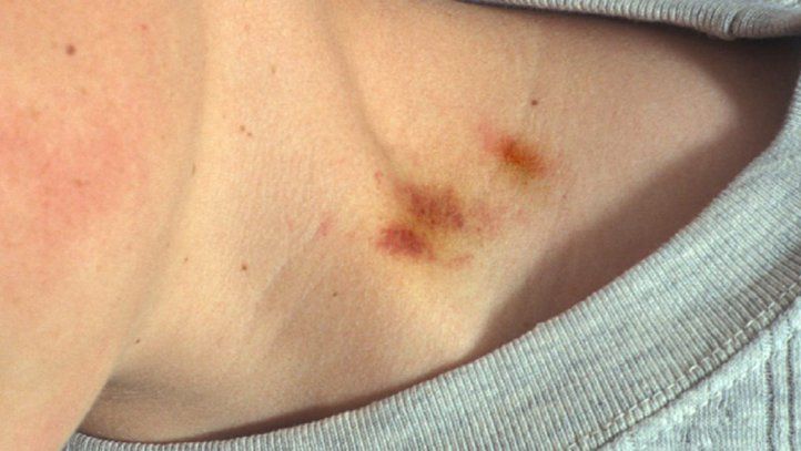 A murit la câteva ore după ce a fost muşcat de gât de iubita sa. Şocant! Ce s-a aflat la autopsie