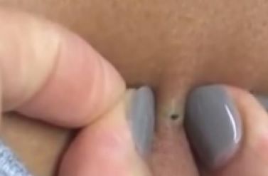 A găsit un punct negru pe gâtul iubitului. A apăsat tare pe el şi s-a SPERIAT când a văzut ce iese