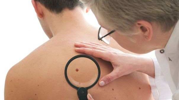 Ai multe aluniţe pe corp? Cât de mult îţi influenţează sănătatea apariţia acestora