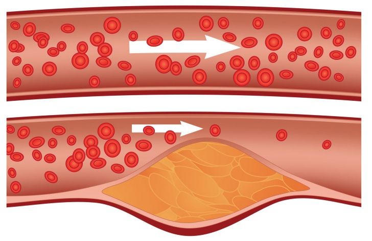 Cum îţi poţi curăţa vasele de sânge de colesterol în doar 40 de zile. Ai nevoie de 3 ingrediente
