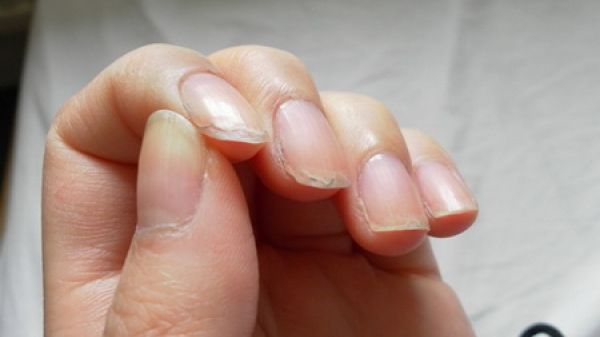 Ai unghiile exfoliate? Vezi ce încearcă organismul să îți transmită