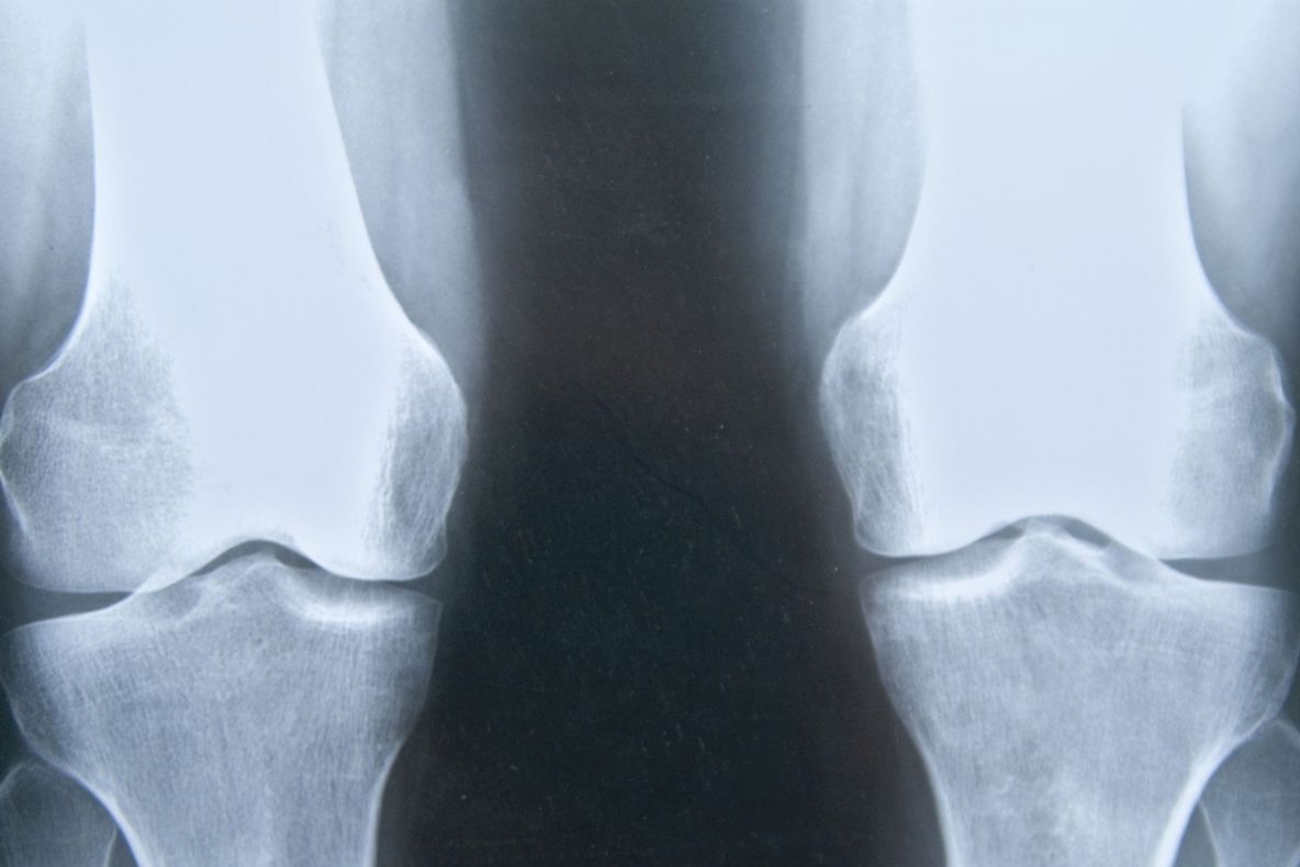 Această OTRAVĂ pe care și tu o consumi îți distruge oasele!