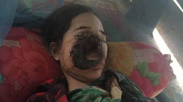 Tânără mutilată pe viaţă după o consultaţie la dentist! O bacterie a început să-i distrugă faţa