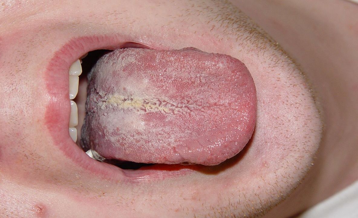 Dacă ai aşa ceva pe limbă trebuie să mergi la medic! Ce este candidoza bucală şi când apare
