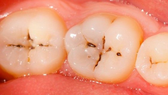 Ţi-e frică de dentist, dar ţi-au apărut carii? Uite cum poţi scăpa de ele chiar la tine acasă