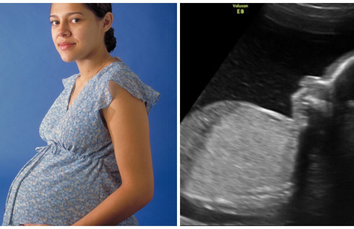 Întâi a aflat că e însărcinată, apoi a primit vestea: "Va muri!". Decizia femeii a fost clară