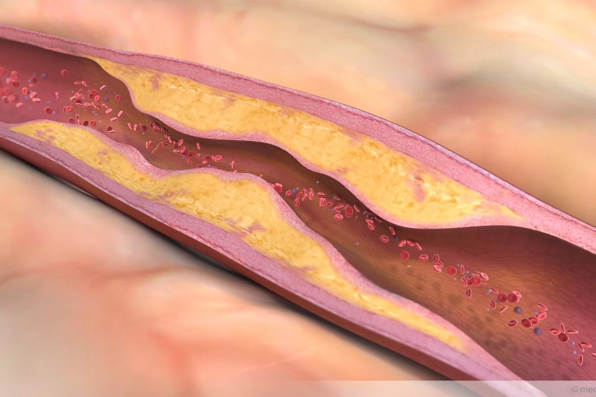 Remedii naturiste pentru arteroscleroză. Nu renunțați, însă, la medicamente