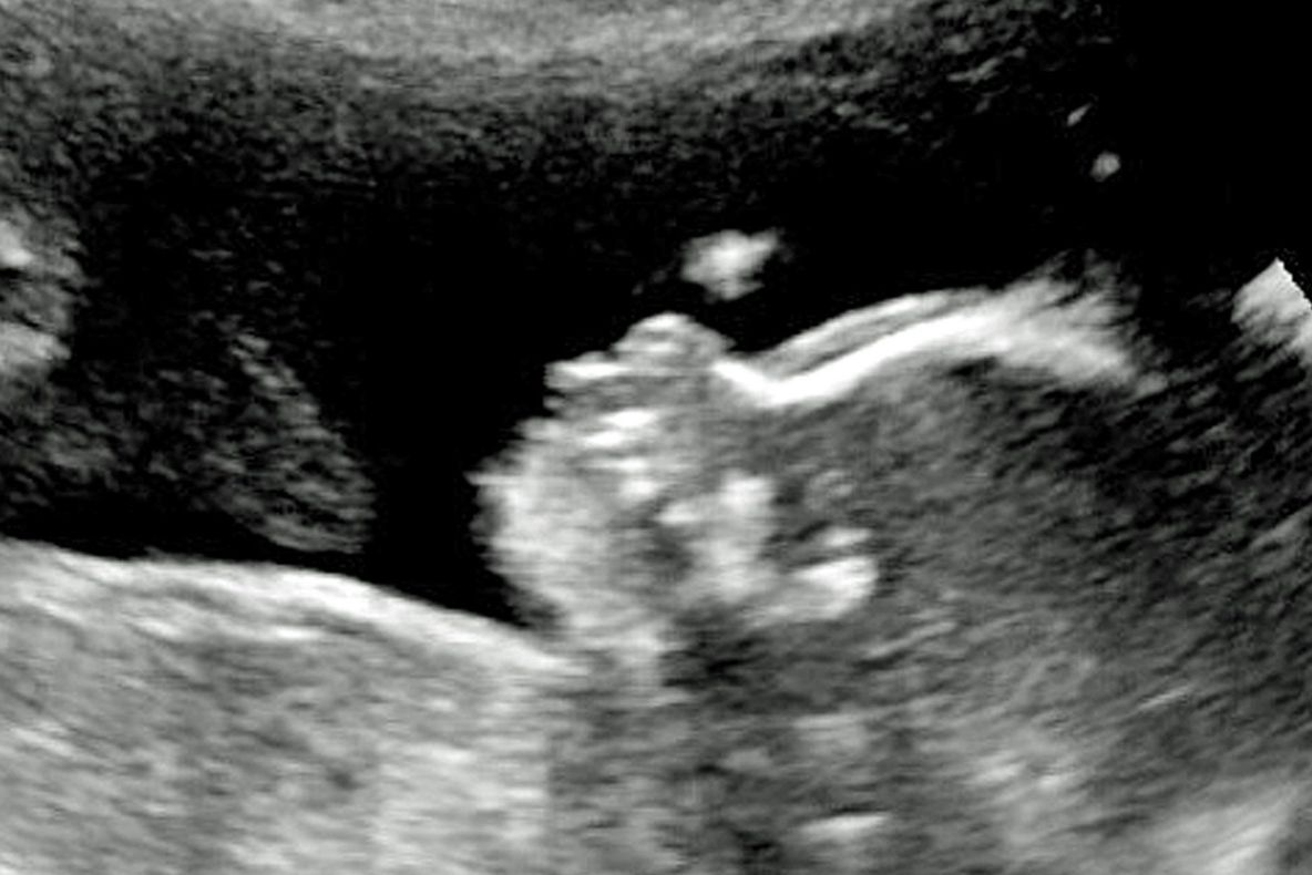 Caz unic în lume!A făcut ecografie să vadă dacă bebelușul e bine, dar ce s-a văzut i-a uimit pe toți