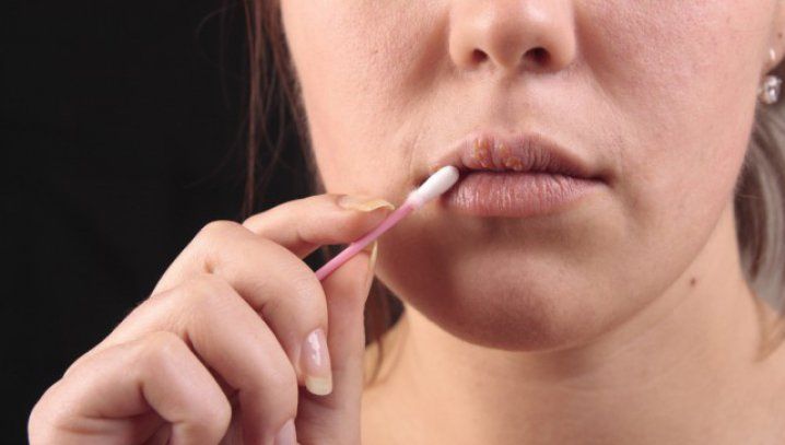 Remediul care vindecă HERPESUL peste noapte