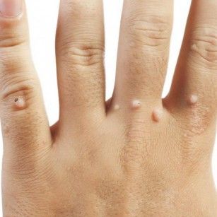 Cum poți scăpa  de negi cu tratamente pe care le poți face acasă, din ingrediente foarte ieftine 