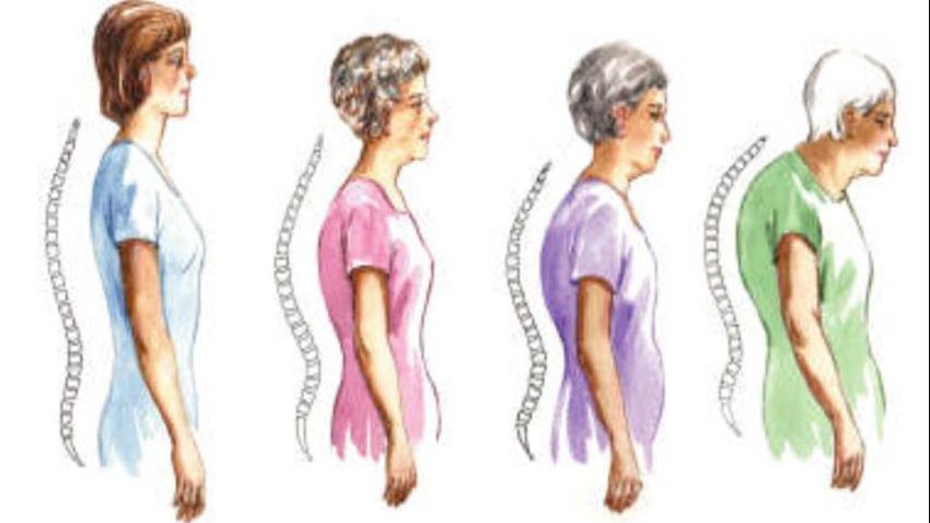 Cum prevenim osteoporoza cel mai simplu