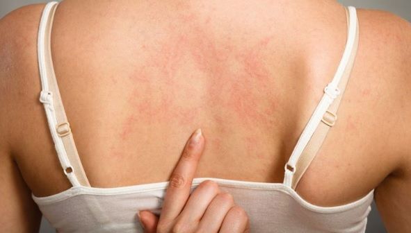 A doua zi după moartea subită a tatălui, adolescenta s-a trezit cu pete roșii pe tot corpul