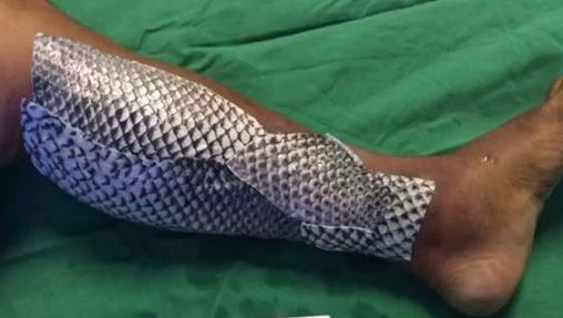 Medicii i-au pus piele de peşte pe picior. Motivul este uimitor. Acum, s-a vindecat!