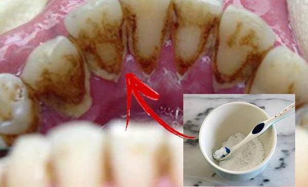 Cum scapi RAPID de tartru de pe dinți fără să mergi la dentist