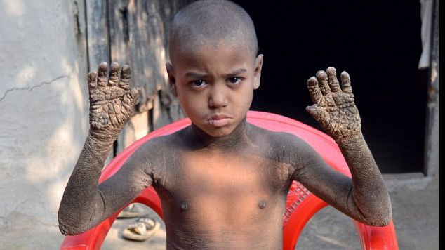 Copilul de 8 ani care se transformă în piatră a sfidat destinul. Medicii sunt siderați