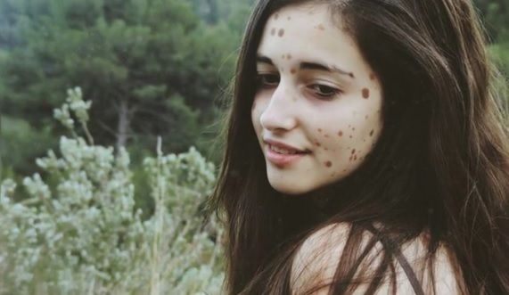 S-a născut cu 500 semne distinctive pe corp. Râdeau de ea.Dar a crescut, a ajuns top-model.Cum arată