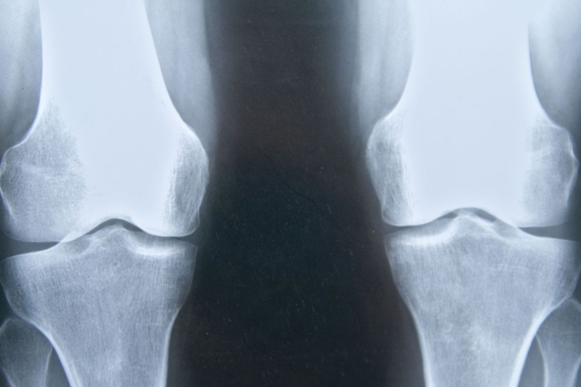 Ai probleme cu articulațiile? Verifică sistemul endocrin!