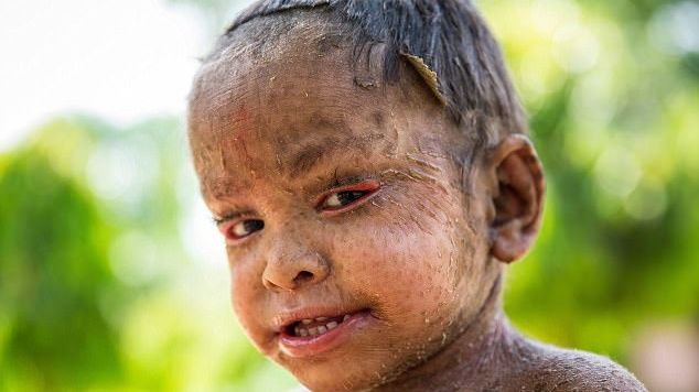 Are numai 2 ani şi suferă de boala şopârlei! Cum se manifestă această boală rară