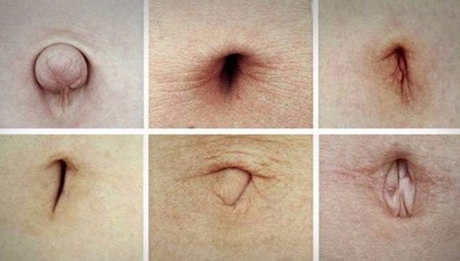 Ce spune forma buricului despre sănătatea ta. Ar trebui să consulţi un medic urgent dacă îl ai aşa