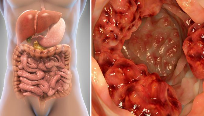 Ai aceste simptome? Mergi de URGENŢĂ la medic! E cancer de colon